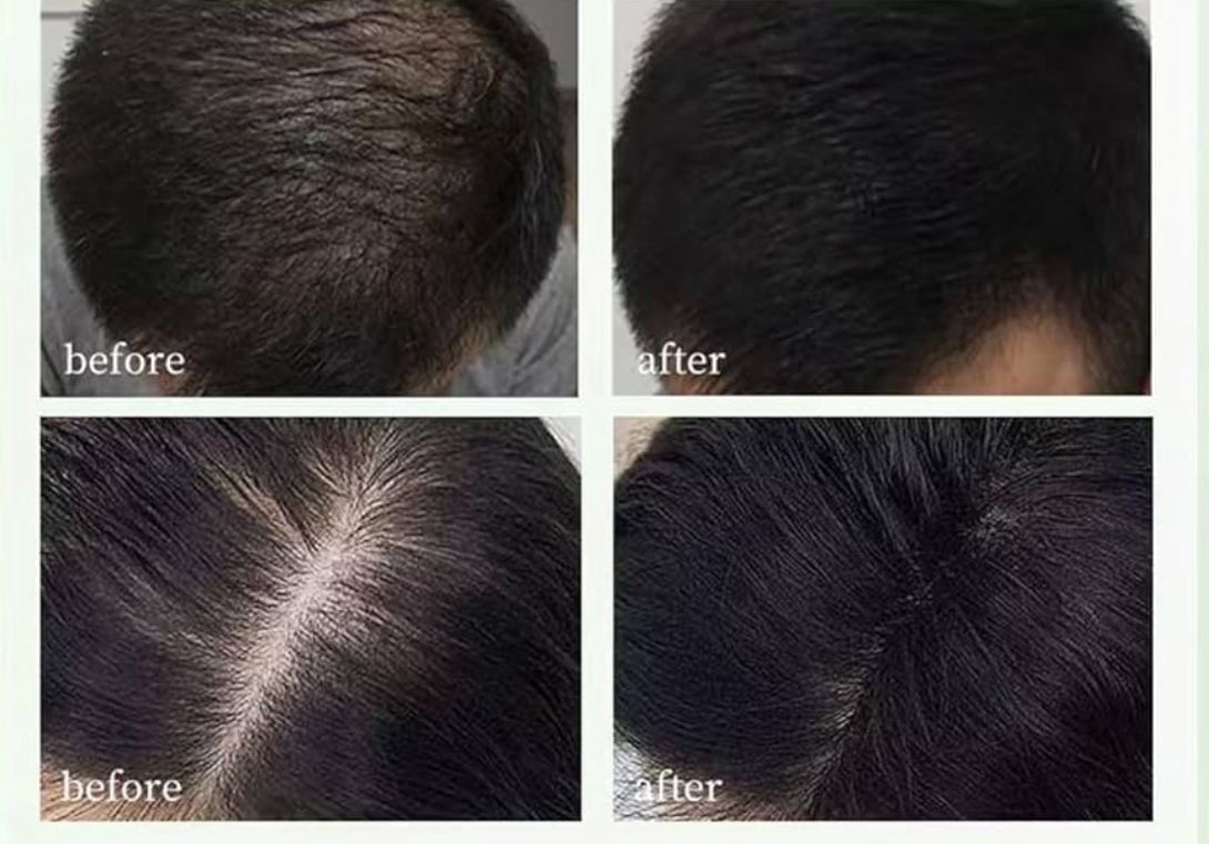 NaturaLuxe™ - Antidandruff Pro /Support Hair Growth