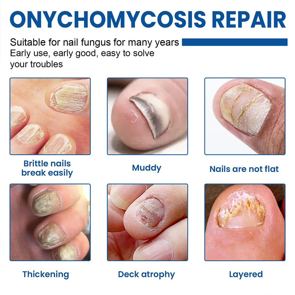 FungalFix™ - Fungal Nail Renewal Patches