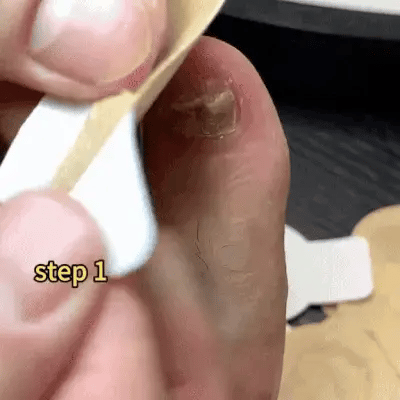 FungalFix™ - Fungal Nail Renewal Patches